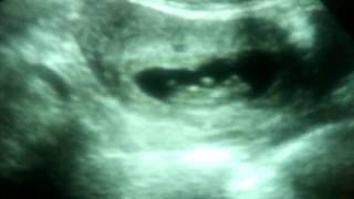 feto de 10 semanas 2 días con movimientos espontáneos Fetal of 10 weeks with spontaneous movements [upl. by Ycal]