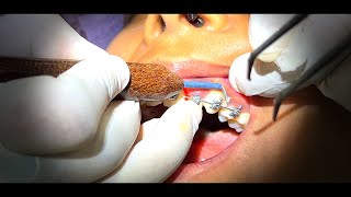 Gingivectomy in an Orthodontic Patient with swollen gums [upl. by Ellennoj]