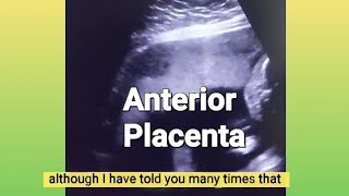 Anterior placenta baby gender  12 weeks Twin pregnancy  3 vessel cord or turtle sign  ultrasound [upl. by Kcirdle]