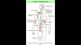 Virchows Node Abdominal Metastasis [upl. by Zola]