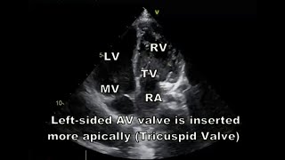 Transposition of the Great Arteries [upl. by Ki]