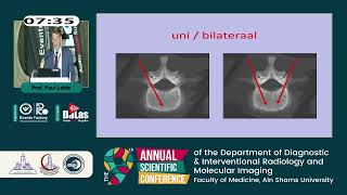 Percutaneous Vertebroplasty [upl. by Nwahsyd583]