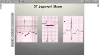 Effects of Ischemia on the ECG [upl. by Colan]