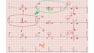 ECG de A à Z  Les ondes PQRST prt 2 [upl. by Wessling]