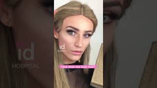 Amazing Facial Feminization Surgery Transformation idhospital shortsfeed [upl. by Hagep990]