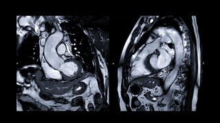 Cardiac MRI Mayo Clinic amp British Cardiac Society Board Review [upl. by Ecnarwal]