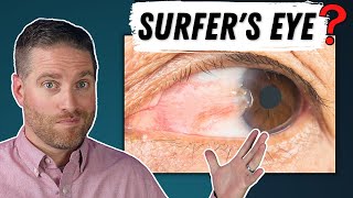 Surfers Eye  Pterygium Explained Growth On Your Eye [upl. by Loy]