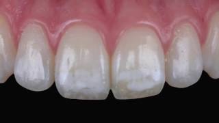 Tratamiento de la fluorosis mediante infiltración ICON [upl. by Cela]