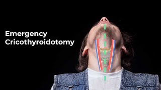 Performing an Emergent Cricothyroidotomy  MEDZCOOL [upl. by Atlas]