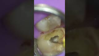 Molar Root Canal  Finding MB2 [upl. by Enilesoj]