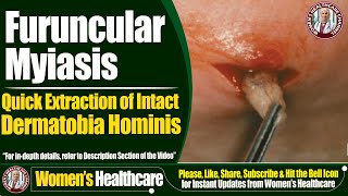 Furuncular Myiasis  Quick Extraction of Intact Dermatobia Hominis  Womens Healthcare [upl. by Laikeze]