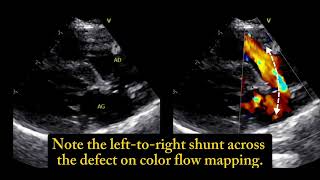 Ostium secundum atrial septal defect a 6 monthold cat 🐱 [upl. by Irpak55]