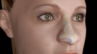 Bulbous Large Nasal Tip Nose Job Rhinoplasty [upl. by Aliuqaj]