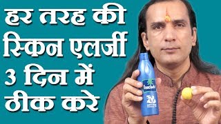 स्किन एलर्जी का घरेलू नुस्खा How To Cure Skin Allergy  skin allergy treatment at home Sachin Goyal [upl. by Coffey475]