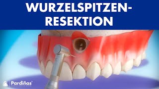 Wurzelspitzenresektion © [upl. by Nonek]