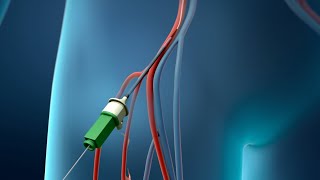 Coronary Angioplasty Femoral Access [upl. by Mccafferty]