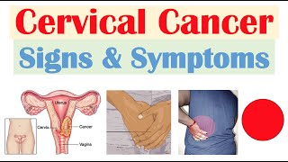 Cervical Cancer Signs amp Symptoms amp Why They Occur [upl. by Jessalyn]