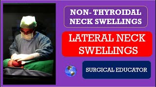 LATERAL NECK SWELLINGS Nonthyroidal Neck Swellings [upl. by Enelak]