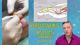 Percutaneous Tenotomy Explained  By Dr Roger Kilfoil ASMR Bonus at the end [upl. by Nerra]