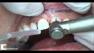 Preparation Six Maxillary Anterior Veneers by Dr Ed McLaren [upl. by Lednyk]