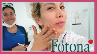 💜fotona intraoral mi experiencia con laser rejuvenecimiento [upl. by Nairret]