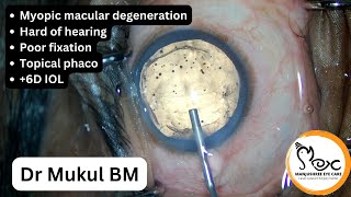 Myopic macular degen Topical phaco  6D IOL [upl. by Jerrie]