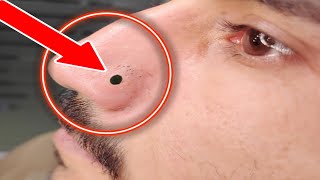 Say Goodbye to Nose Blackheads with Expert Tips and Techniques [upl. by Derag]