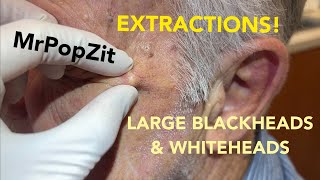 Awesome acne extractions Some solar comedones Favre some regular blackheads and whiteheads [upl. by Heinrik]