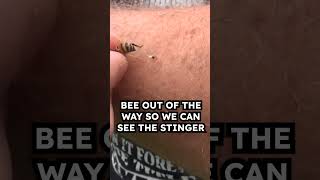 How to Remove Bee Sting [upl. by Frankie]