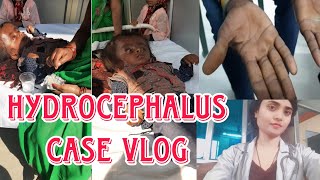 Hydrocephalus Disease HOMEOPATHIC TREATMENT doclifestyle9646 🩺🌸 [upl. by Adoree]