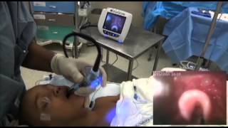 GlideScope Pediatric Airway Rounds Case Study 3 year old Umbilical Hernia Repair [upl. by Perkins]