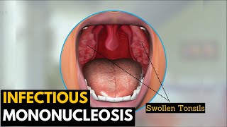 Infectious mononucleosis Causes Signs and Symptoms Diagnosis and Treatment [upl. by Donnamarie]