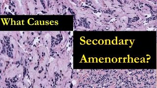 What Causes Secondary Amenorrhea  Reasons for Missed Periods but not Pregnancy [upl. by Runck]