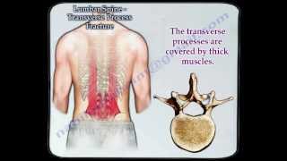 Lumbar Spine Transverse Process Fracture  Everything You Need To Know  Dr Nabil Ebraheim [upl. by Larret422]