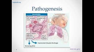 Bronchiolitis 8 31 24 [upl. by Esirehc217]