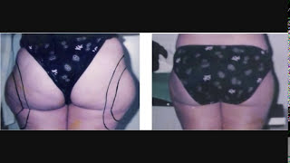 شفط الدهون المغرب بالتخدير الموضعي Liposuction  Liposuccion Maroc  Gynécomastie  Abdominoplastie [upl. by Goldwin203]