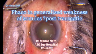 Phaco in generalised weakness of zonules post trauma [upl. by Hpesoj]