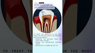 Basics About Root Canal Treatment dentist rootcanaltreatment [upl. by Kciredec]