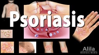 Psoriasis Types Symptoms Causes Pathology and Treatment Animation [upl. by Carlin]