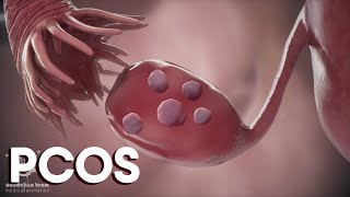 menstruation and Polycystic Ovary Syndrome or PCOS  Causes TreatmentsDandelion Medical Animation [upl. by Vedis]