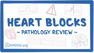 Heart blocks Pathology Review [upl. by Mueller]