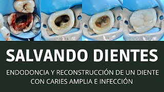 SALVANDO DIENTES Endodoncia y reconstrucción de un diente con caries amplia e infección [upl. by Aloysia]