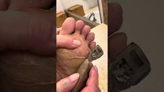 EXTREME CALLUS Shaving Removal Clipping ASMR Pedicure  Hyperkeratosis EPPK Foot  Nov 28 2023 [upl. by Teuton386]