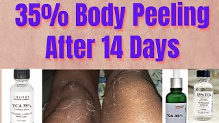 35 TCA Chemical Peel Before After Body Peeling After 14 Day पीलिंग देर से हुई [upl. by Nerti]