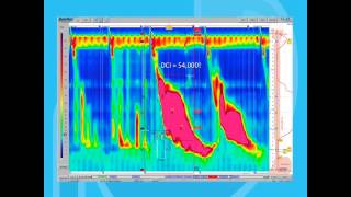 Esophageal Motility Disorders Part 2 [upl. by Ytirehc21]