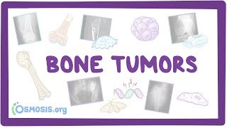 Bone tumors  causes symptoms diagnosis treatment pathology [upl. by Nnaes139]