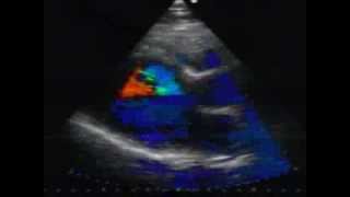 Hypertrophic cardiomyopathy echo case by dr Chatziathanasiou [upl. by Nauqan594]