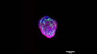 Heart organoids simulate pregestational diabetesinduced congenital heart disease [upl. by Nilad]