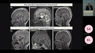 Pediatric Craniopharyngioma Pt1 Craniopharyngioma  Overview and Classification [upl. by Mariande]