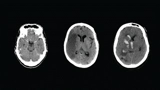 How to Read a CT Scan of the Head  MEDZCOOL [upl. by Ciredec]